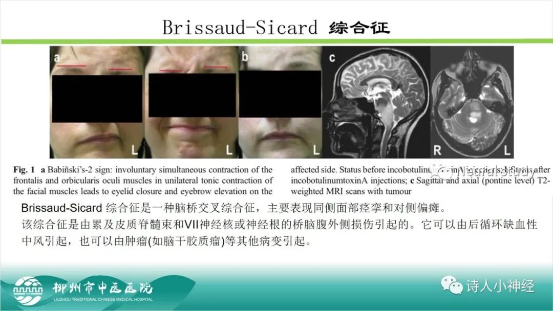 影像PPT - 【PPT】各种脑干梗死综合征临床解剖及影像-40