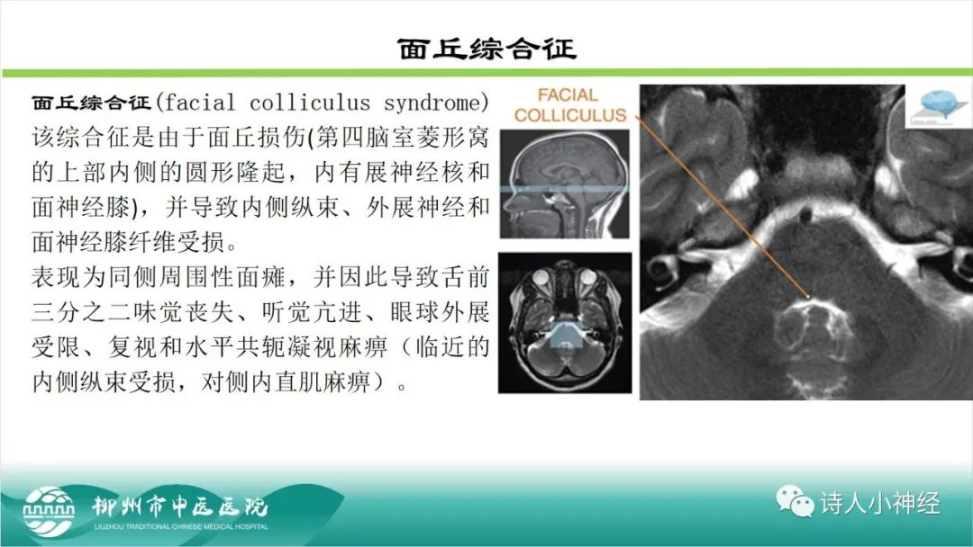 影像PPT - 【PPT】各种脑干梗死综合征临床解剖及影像-41