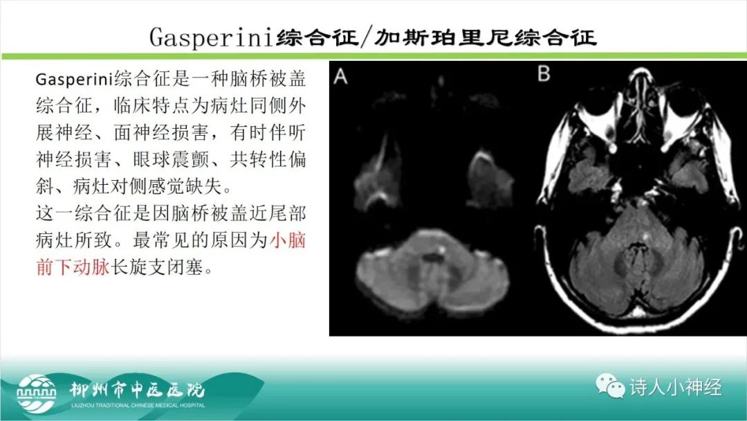 影像PPT - 【PPT】各种脑干梗死综合征临床解剖及影像-44