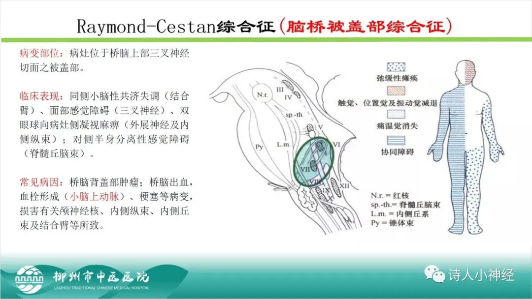 影像PPT - 【PPT】各种脑干梗死综合征临床解剖及影像-45