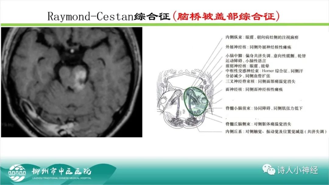 影像PPT - 【PPT】各种脑干梗死综合征临床解剖及影像-48