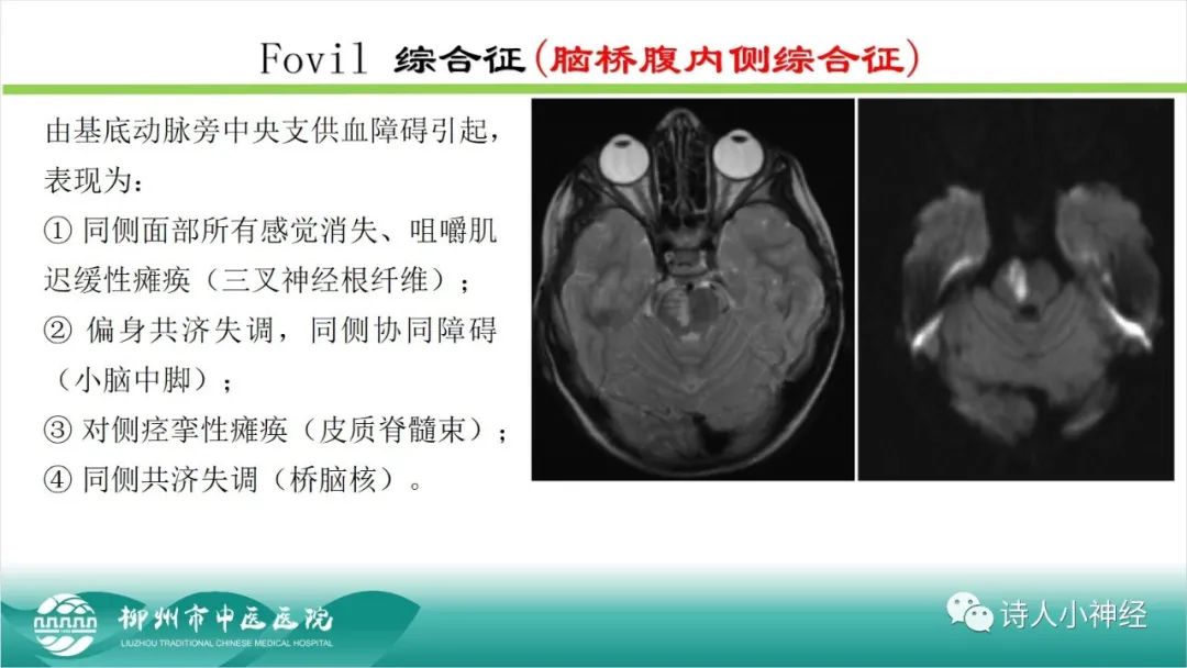 影像PPT - 【PPT】各种脑干梗死综合征临床解剖及影像-54