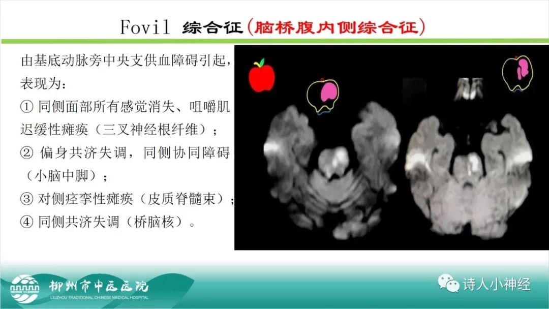 影像PPT - 【PPT】各种脑干梗死综合征临床解剖及影像-53