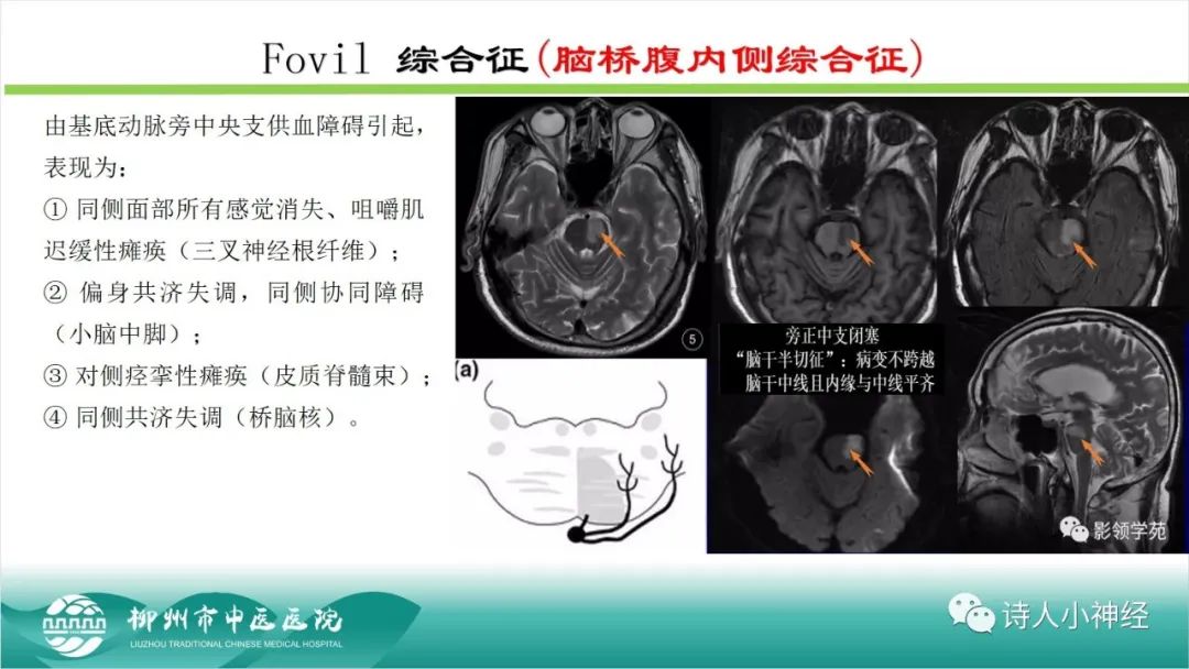影像PPT - 【PPT】各种脑干梗死综合征临床解剖及影像-55