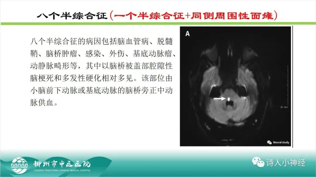 影像PPT - 【PPT】各种脑干梗死综合征临床解剖及影像-57