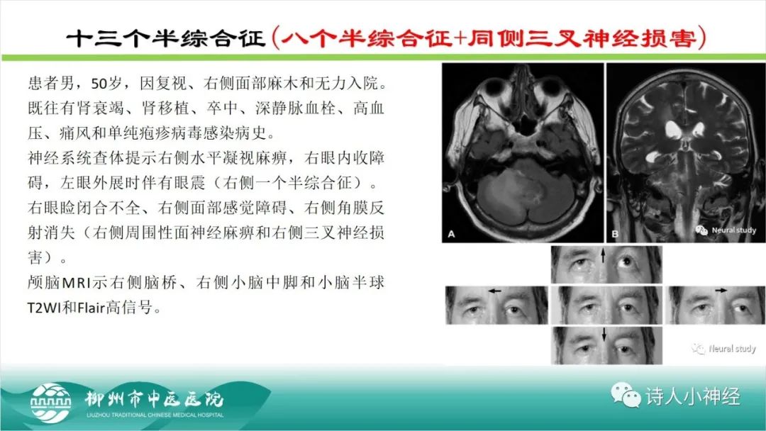 影像PPT - 【PPT】各种脑干梗死综合征临床解剖及影像-59