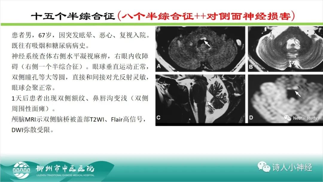 影像PPT - 【PPT】各种脑干梗死综合征临床解剖及影像-60