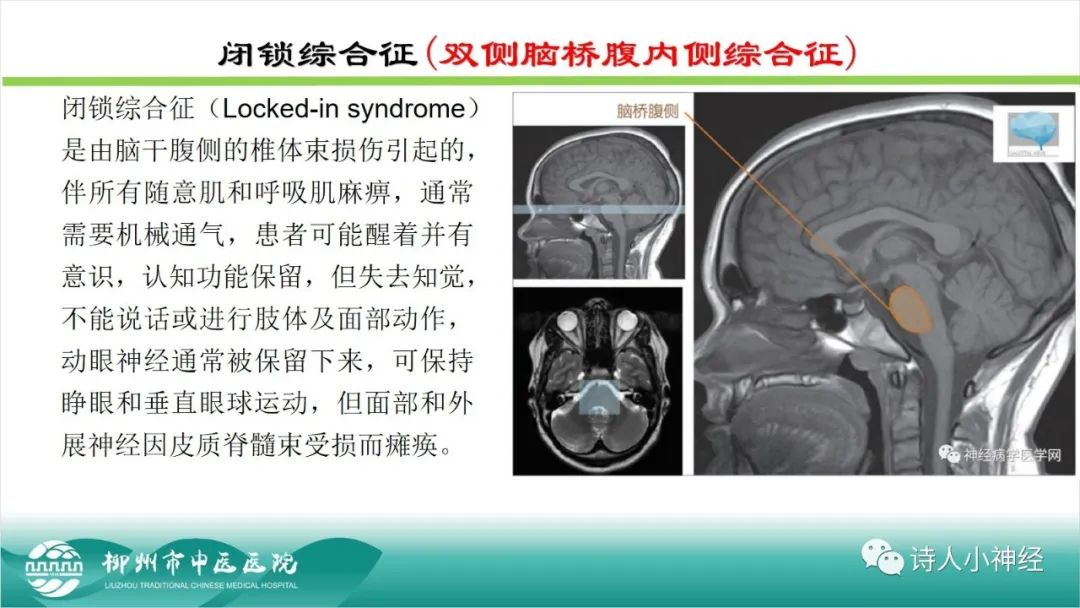 影像PPT - 【PPT】各种脑干梗死综合征临床解剖及影像-62