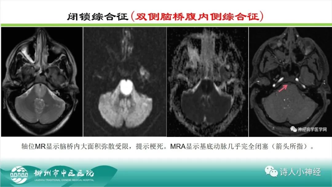 影像PPT - 【PPT】各种脑干梗死综合征临床解剖及影像-63