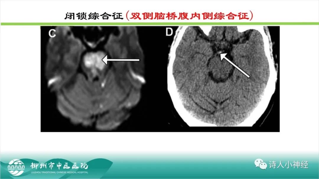 影像PPT - 【PPT】各种脑干梗死综合征临床解剖及影像-64