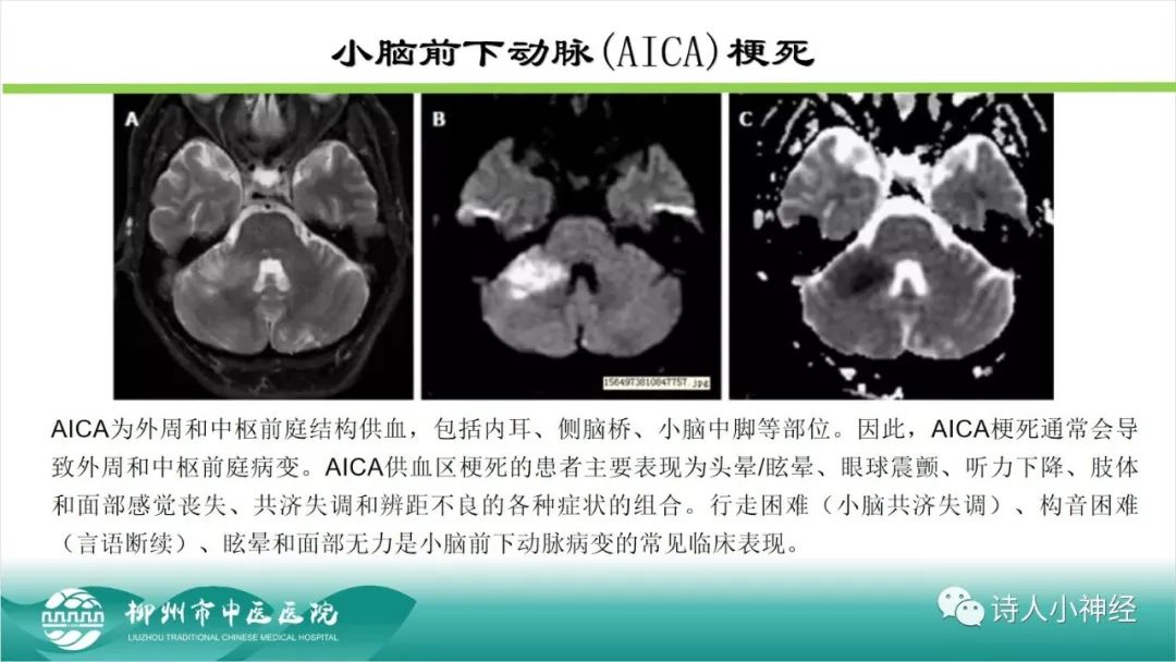 影像PPT - 【PPT】各种脑干梗死综合征临床解剖及影像-66