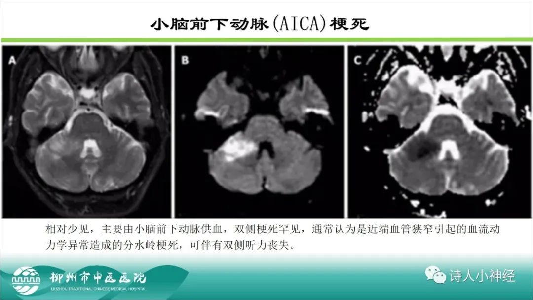 影像PPT - 【PPT】各种脑干梗死综合征临床解剖及影像-67