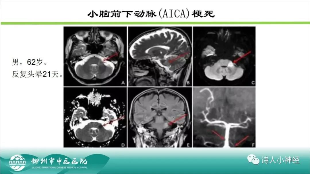 影像PPT - 【PPT】各种脑干梗死综合征临床解剖及影像-68
