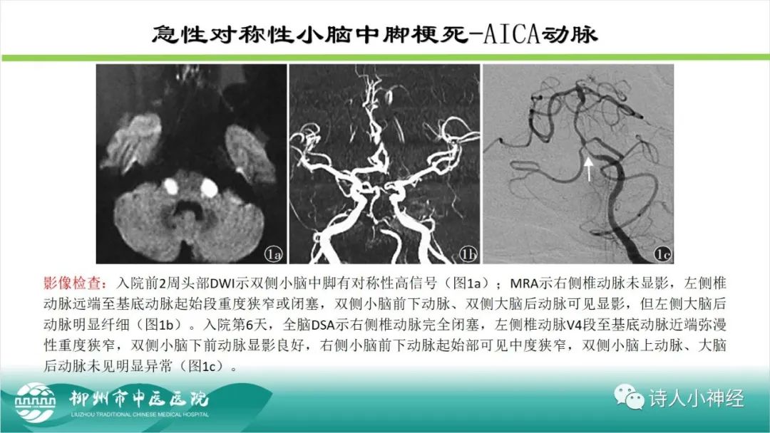 影像PPT - 【PPT】各种脑干梗死综合征临床解剖及影像-72