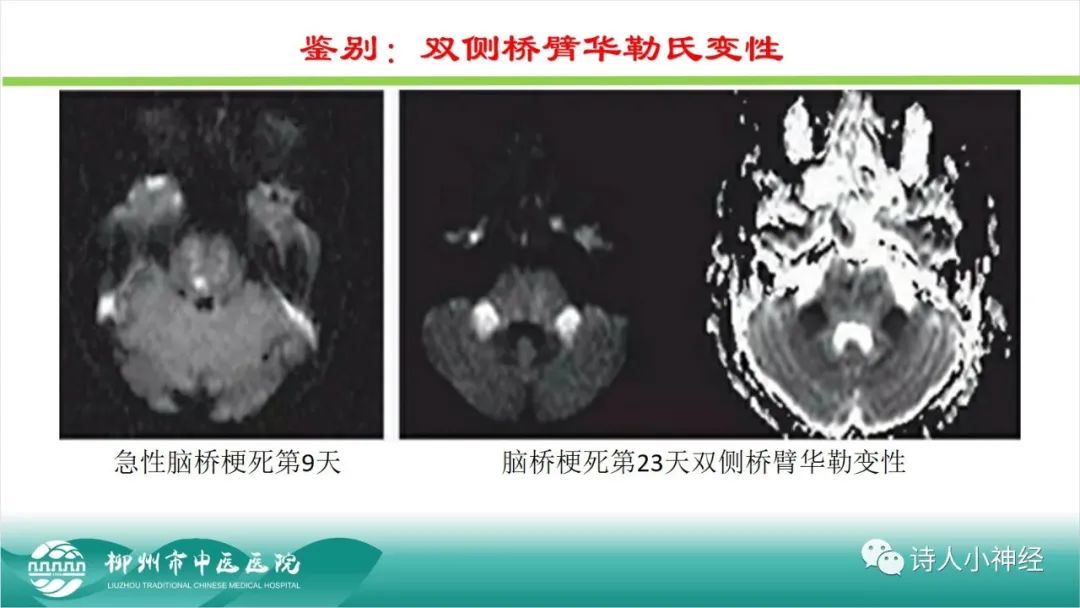 影像PPT - 【PPT】各种脑干梗死综合征临床解剖及影像-74