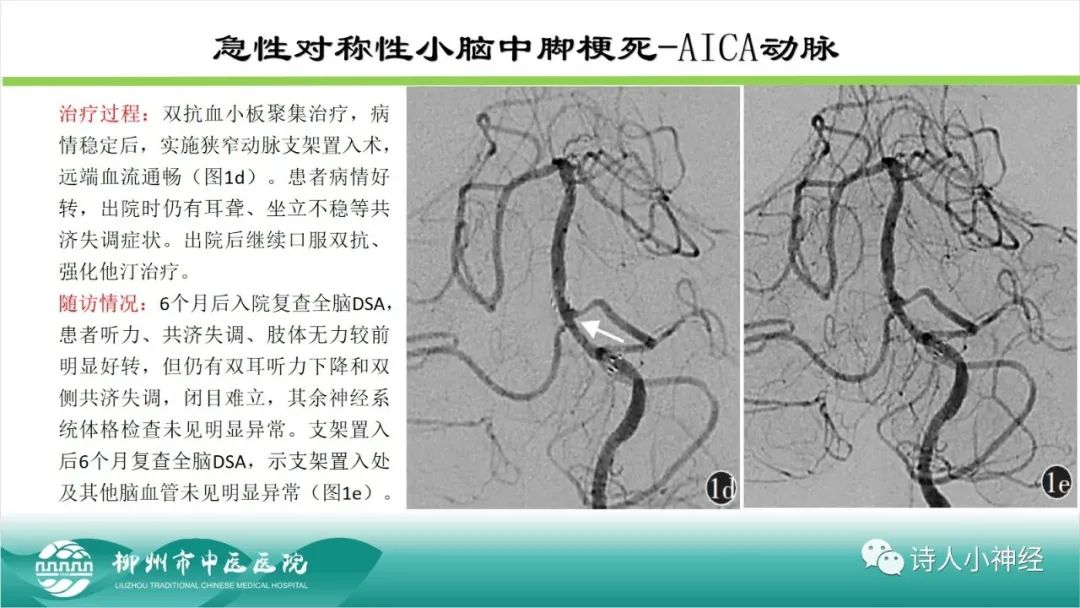 影像PPT - 【PPT】各种脑干梗死综合征临床解剖及影像-73