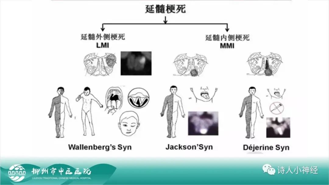 影像PPT - 【PPT】各种脑干梗死综合征临床解剖及影像-78