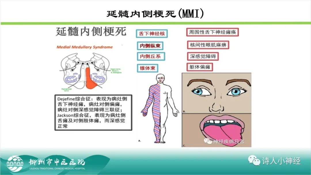 影像PPT - 【PPT】各种脑干梗死综合征临床解剖及影像-80