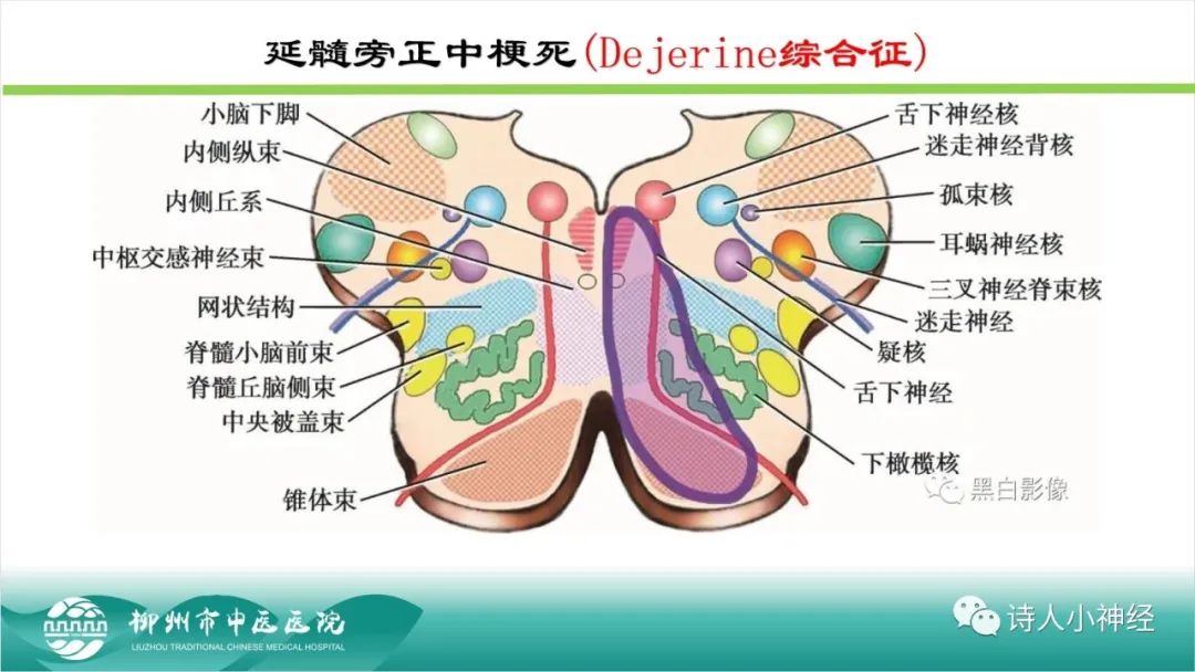影像PPT - 【PPT】各种脑干梗死综合征临床解剖及影像-82