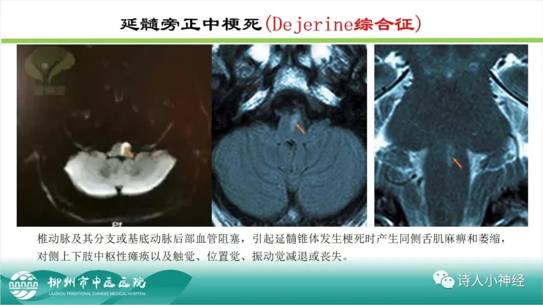 影像PPT - 【PPT】各种脑干梗死综合征临床解剖及影像-84