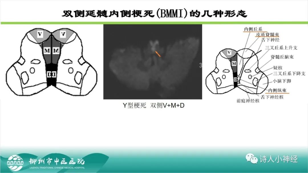 影像PPT - 【PPT】各种脑干梗死综合征临床解剖及影像-86
