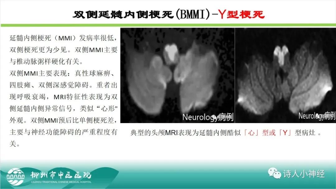 影像PPT - 【PPT】各种脑干梗死综合征临床解剖及影像-89