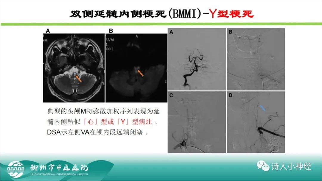 影像PPT - 【PPT】各种脑干梗死综合征临床解剖及影像-90