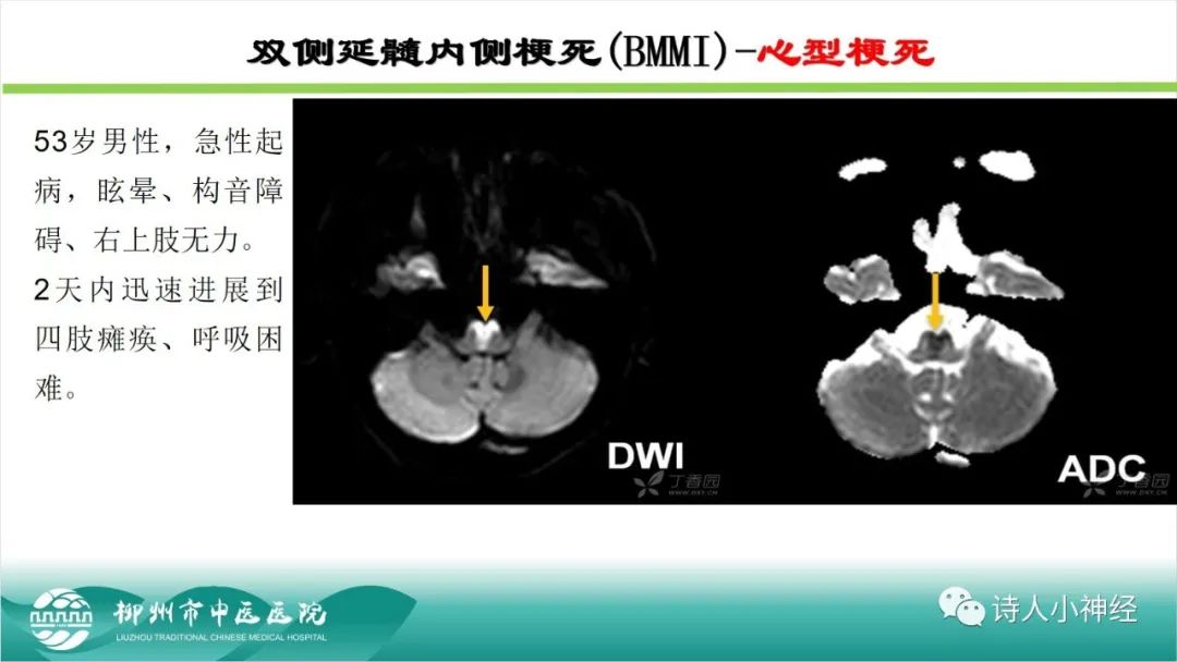 影像PPT - 【PPT】各种脑干梗死综合征临床解剖及影像-91