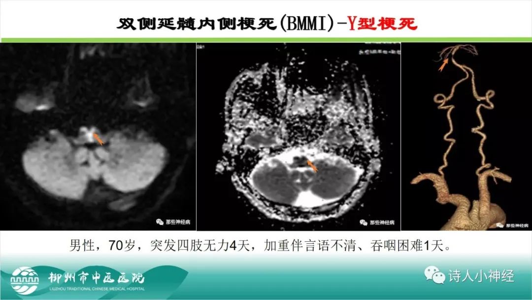 影像PPT - 【PPT】各种脑干梗死综合征临床解剖及影像-93