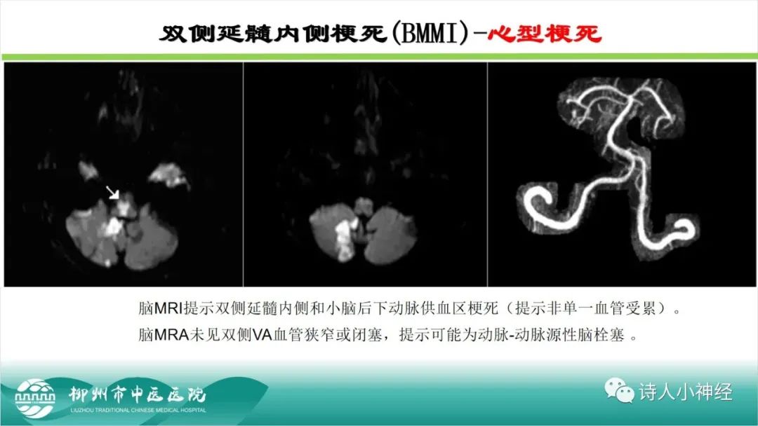 影像PPT - 【PPT】各种脑干梗死综合征临床解剖及影像-96