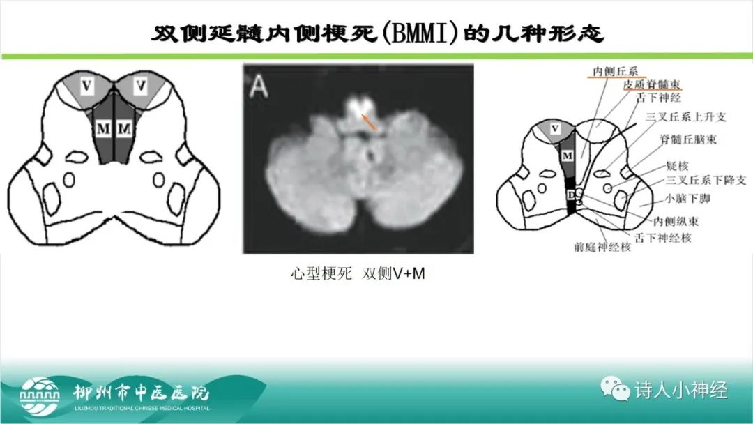 影像PPT - 【PPT】各种脑干梗死综合征临床解剖及影像-97