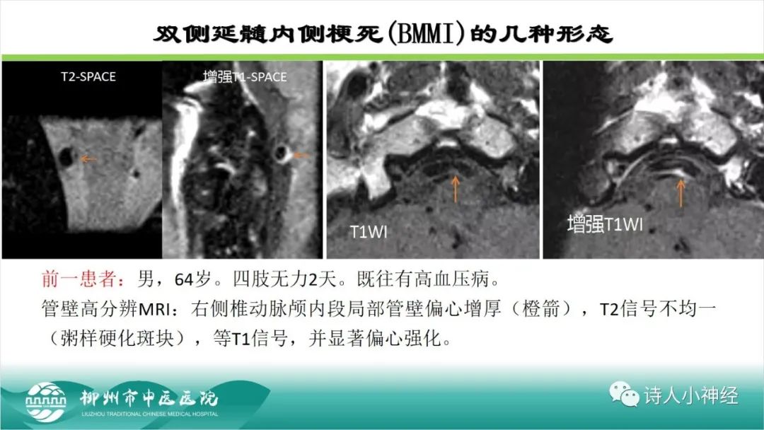 影像PPT - 【PPT】各种脑干梗死综合征临床解剖及影像-100