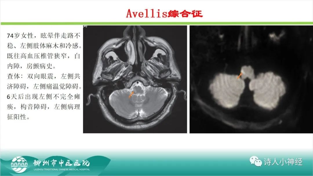 影像PPT - 【PPT】各种脑干梗死综合征临床解剖及影像-102