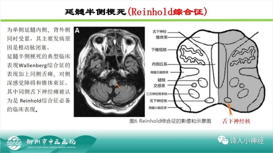 影像PPT - 【PPT】各种脑干梗死综合征临床解剖及影像-105