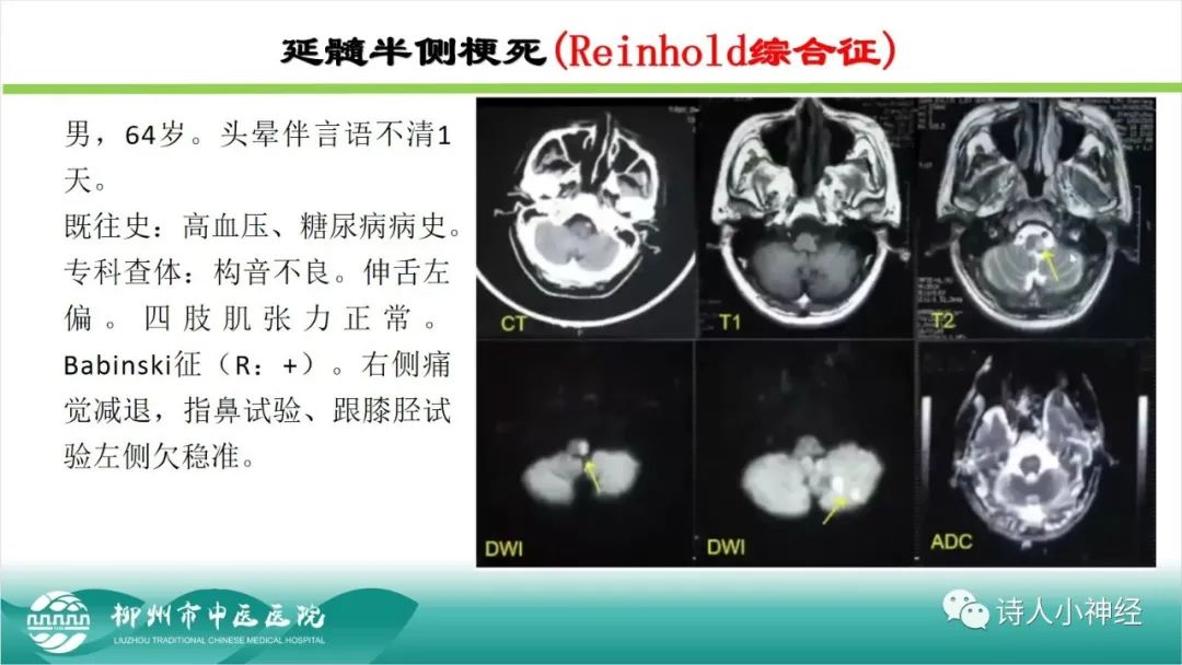 影像PPT - 【PPT】各种脑干梗死综合征临床解剖及影像-106