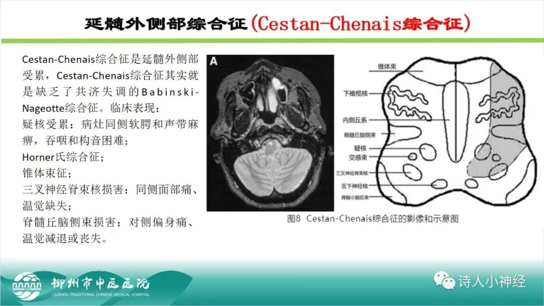 影像PPT - 【PPT】各种脑干梗死综合征临床解剖及影像-109