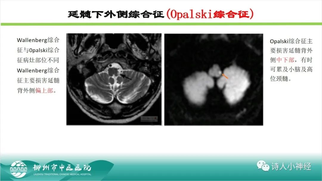影像PPT - 【PPT】各种脑干梗死综合征临床解剖及影像-112