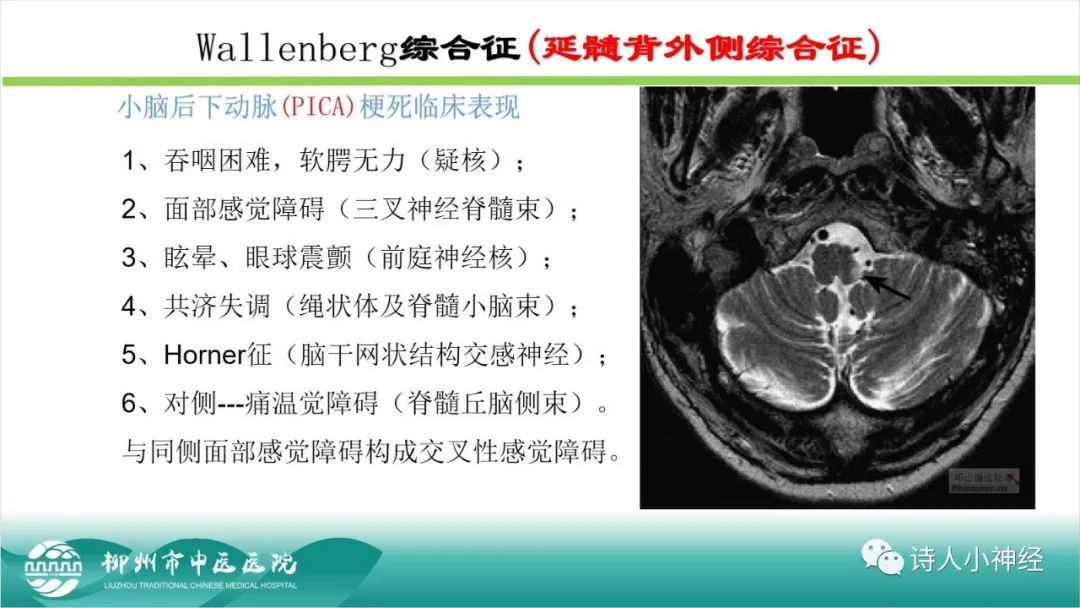 影像PPT - 【PPT】各种脑干梗死综合征临床解剖及影像-114