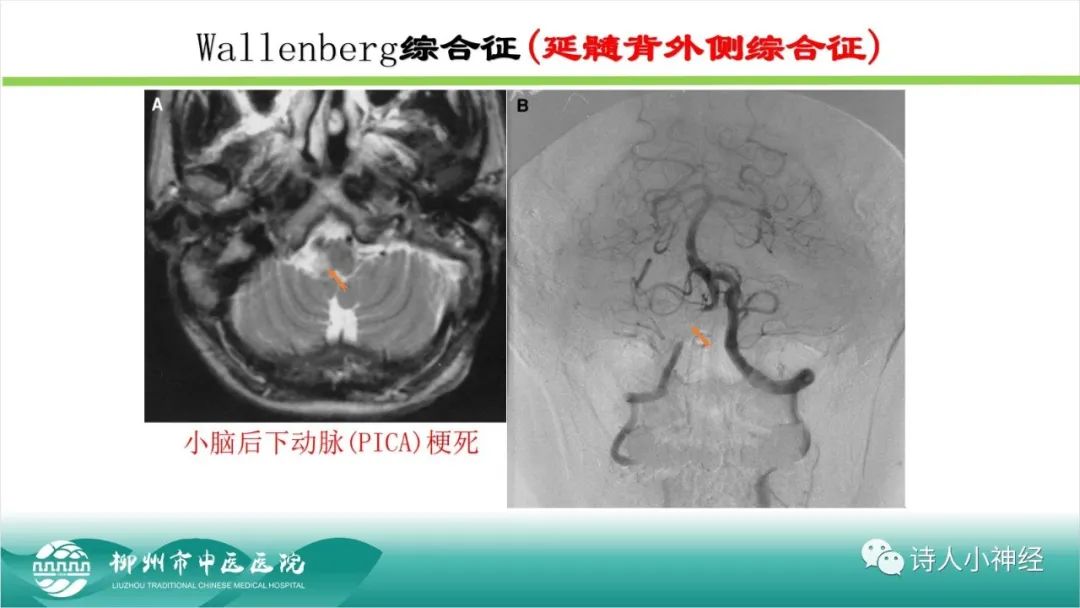 影像PPT - 【PPT】各种脑干梗死综合征临床解剖及影像-115