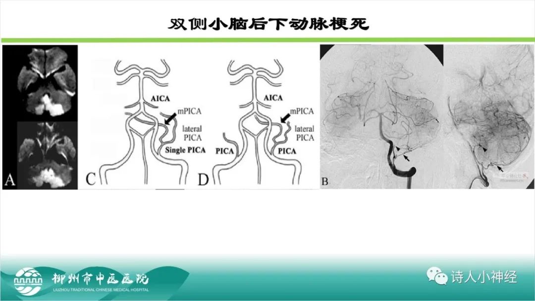 影像PPT - 【PPT】各种脑干梗死综合征临床解剖及影像-116