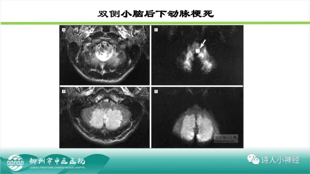 影像PPT - 【PPT】各种脑干梗死综合征临床解剖及影像-117