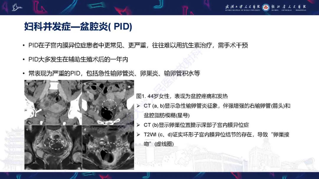 影像PPT - 【PPT】子宫内膜异位症并发症影像诊断-5