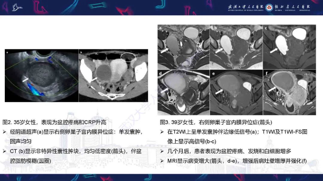 影像PPT - 【PPT】子宫内膜异位症并发症影像诊断-7