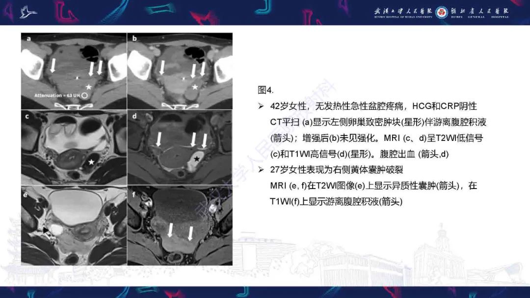 影像PPT - 【PPT】子宫内膜异位症并发症影像诊断-9