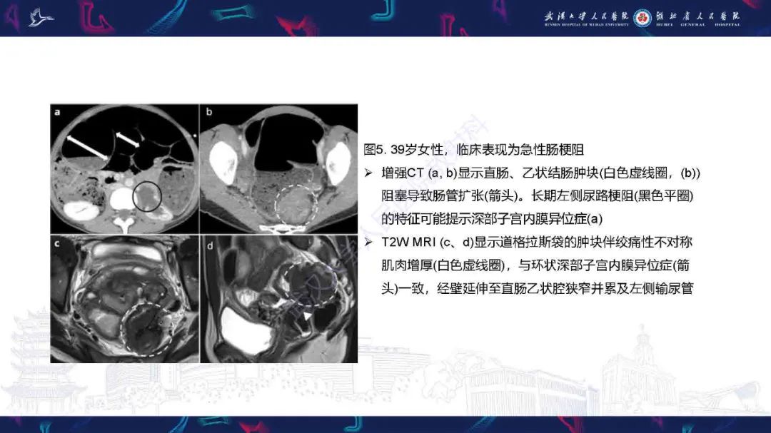 影像PPT - 【PPT】子宫内膜异位症并发症影像诊断-11