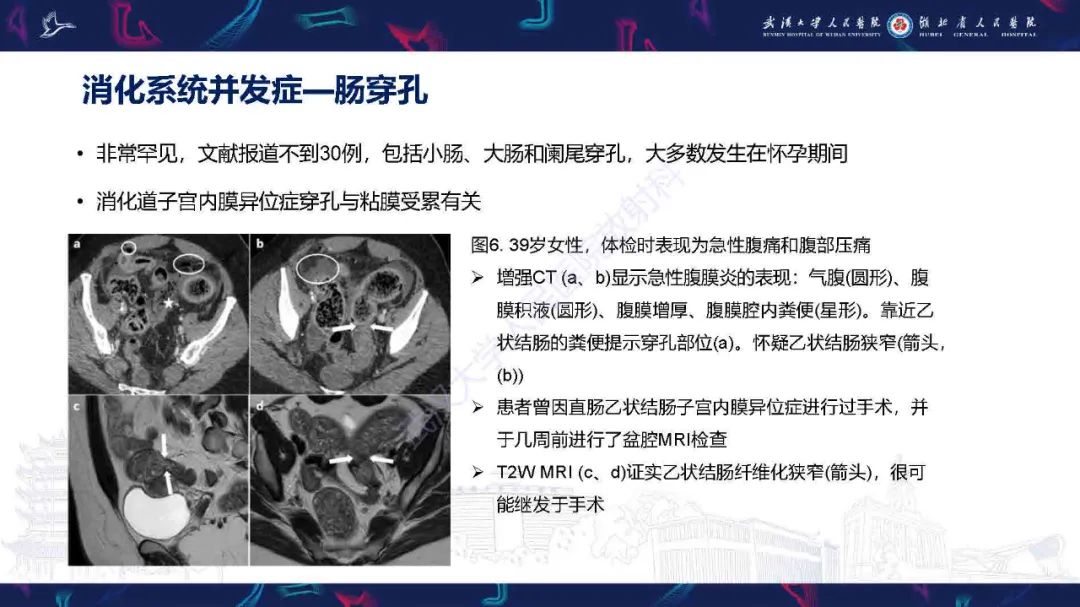 影像PPT - 【PPT】子宫内膜异位症并发症影像诊断-12