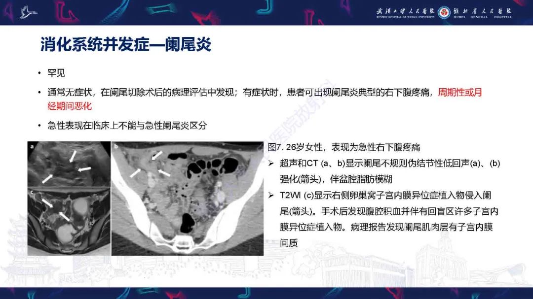影像PPT - 【PPT】子宫内膜异位症并发症影像诊断-13