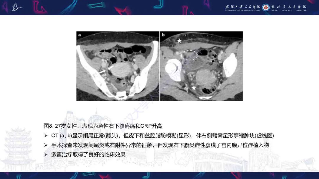 影像PPT - 【PPT】子宫内膜异位症并发症影像诊断-15