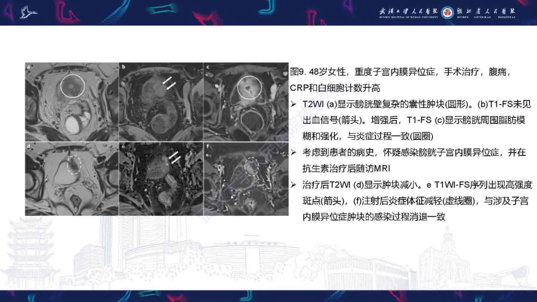 影像PPT - 【PPT】子宫内膜异位症并发症影像诊断-17
