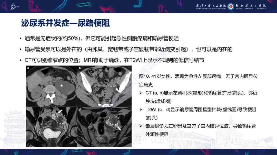 影像PPT - 【PPT】子宫内膜异位症并发症影像诊断-18